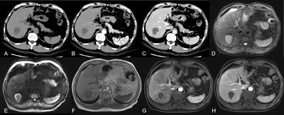 Using a classification model for determining the value of liver radiological reports of patients with colorectal cancer